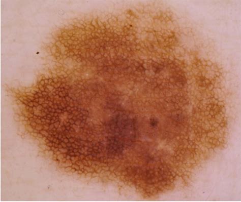 Test image for with nevus containing typical pigmentation network was... | Download Scientific ...