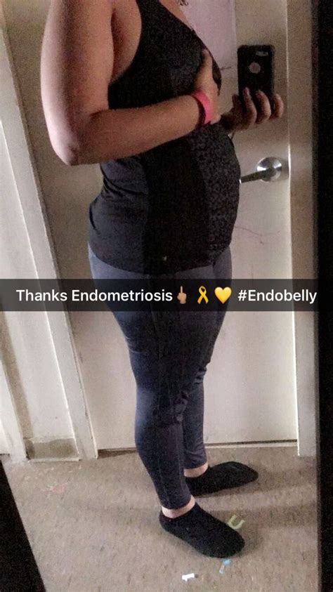 Endo belly... I look pregnant | Endometriosis awareness, Endometriosis and infertility ...