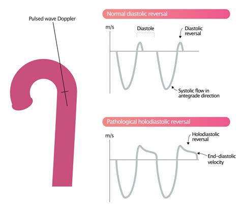 Aortic regurgitation - Echocardiography, diagnosis, grading, severity