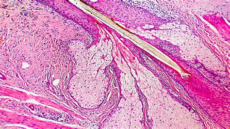 Sebaceous Glands - StoryMD