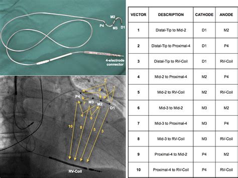 Left ventricular pacing with a new quadripolar transvenous lead for CRT: Early results of a ...