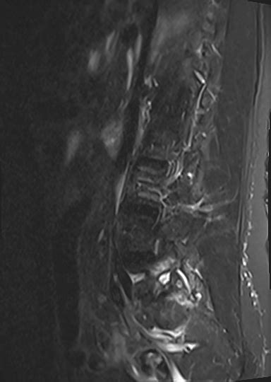 Facet joint arthropathy | Image | Radiopaedia.org