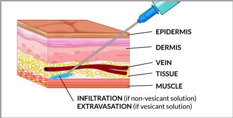 IV Complications Chart