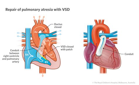 Cardiology : Pulmonary Atresia with VSD