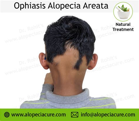 Ophiasis Alopecia Areata