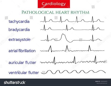 Different Types Of Ecg Strips - Printable Templates Protal