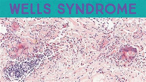 Wells syndrome (eosinophilic cellulitis) with flame figures (video) | KiKo XP