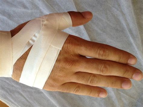 Esguince de los dedos de la mano. - UrbanFisio | Fisioterapia a domicilio y masajes terapéuticos