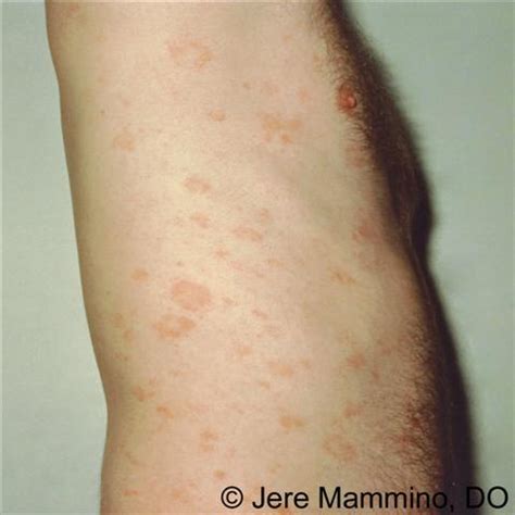 Pityriasis Rosea - American Osteopathic College of Dermatology (AOCD)