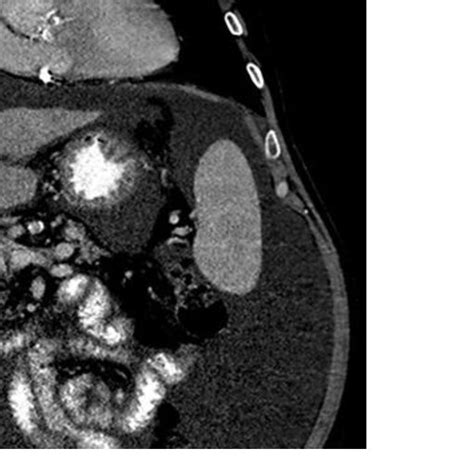 Contrast-enhanced CT scan shows a hypodense lesion in segment 8 (large... | Download Scientific ...