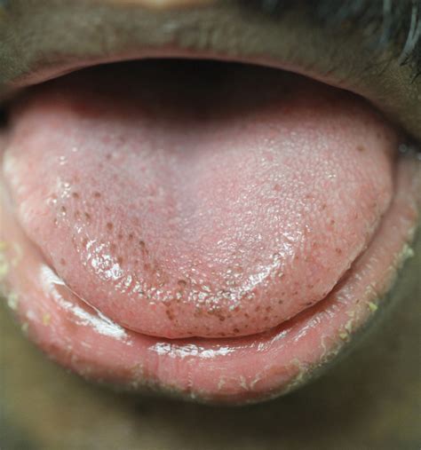 Black Spots On Tongue Causes Prevention Tips And Home - vrogue.co