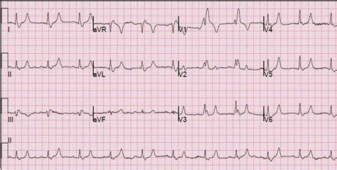 Bundle Branch Block - Causes, Symptoms, Diagnosis, Treatment