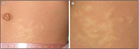 Buschke-Ollendorff syndrome (dermatofibrosis lenticularis disseminata ...