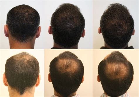 bosley hair transplant locations - Lorilee Chisolm