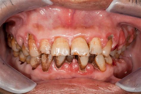 The Difference Between Plaque and Tartar