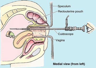 What Is Pouch Of Douglas? Fluid And Endometriosis em 2020 | Arquetipo