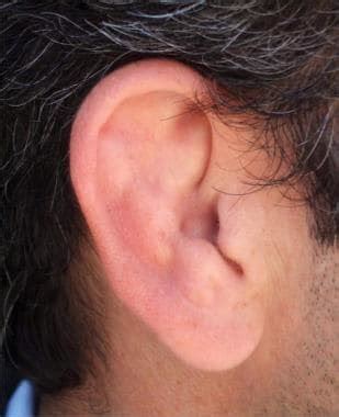 Auricular Hematoma Drainage: Overview, Indications, Contraindications