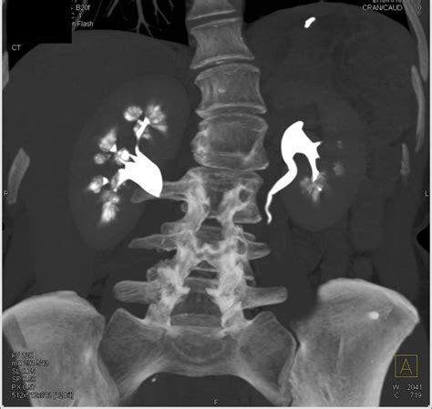 Medullary Sponge Kidney - Kidney Case Studies - CTisus CT Scanning