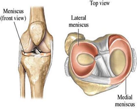 Meniscal Tears | Brisbane Knee and Shoulder Clinic | Dr ...