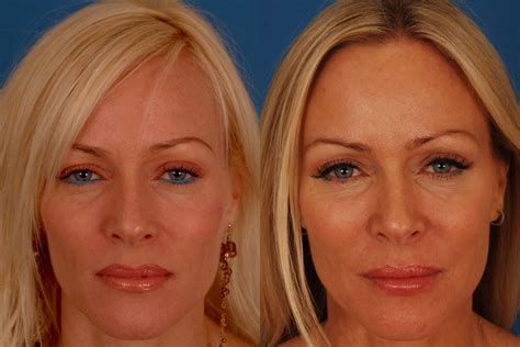 Botox Before & After Photos | Benjamin Bassichis MD, FACS