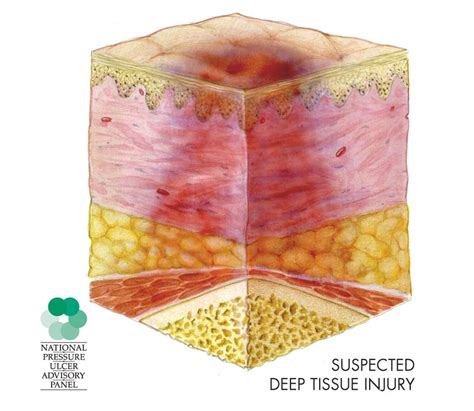 Deep Tissue Injury: What the Eye Can’t See | Wound care expert witness