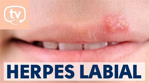 El herpes labial: qué es, causas y tratamiento - YouTube