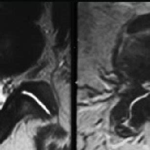 Facet joint disease. Facet joint osteoarthrosis in and facet joint ...