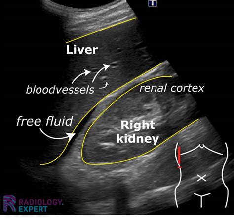 Abdominal ultrasound