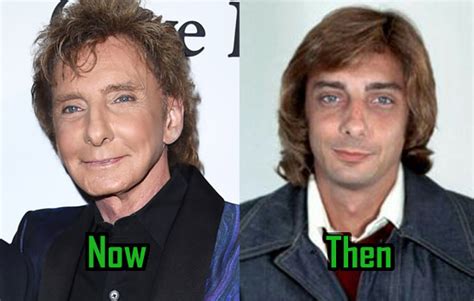 Barry Manilow: Plastic Surgery Transforms His Face | CelebritySurgeryIcon