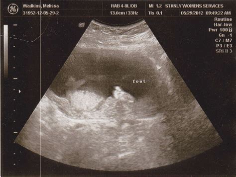 Missy's Journal: 16 Week Ultrasound Pictures