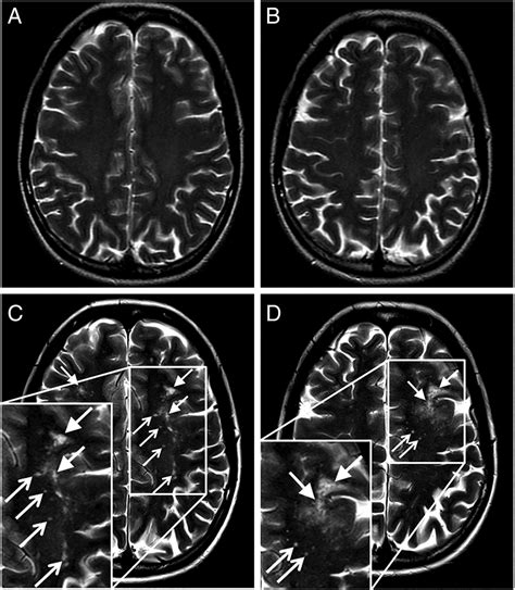 MRI criteria differentiating asymptomatic PML from new MS lesions during natalizumab ...