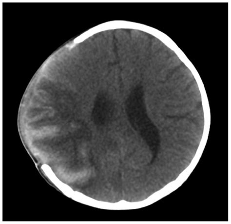 Brain CT at the time of post-operative 7 days revealed sustained brain... | Download Scientific ...