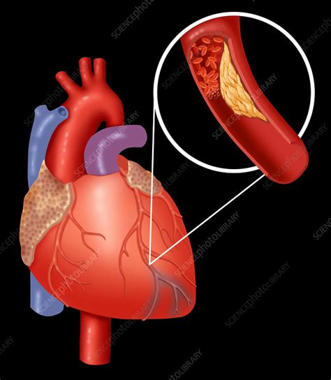 Heart Attack Showing Blood Clot - Stock Image - C017/2661 - Science ...