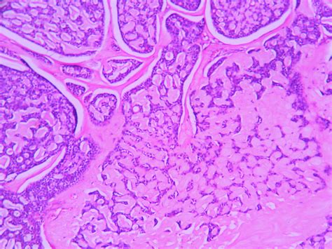 Adenoid cystic carcinoma – Histopathology.guru