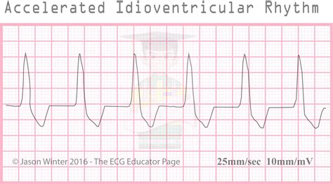 ECG Educator Blog : Ventricular Rhythms