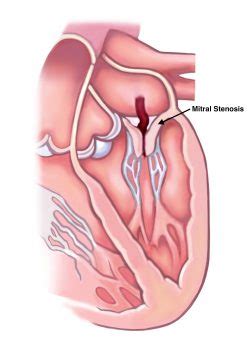 Mitral Valve Stenosis Causes, Symptoms & Treatment