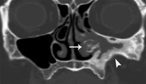 Fungus In Sinus Cavity Symptoms