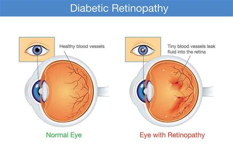 Diabetic Retinopathy: Causes & Treatments | Chelvin Sng Eye Center | Glaucoma | Cataract ...