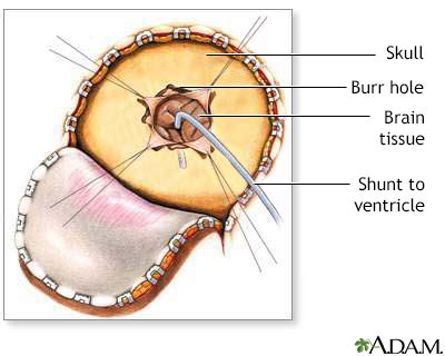 Hydrocephalus Shunt