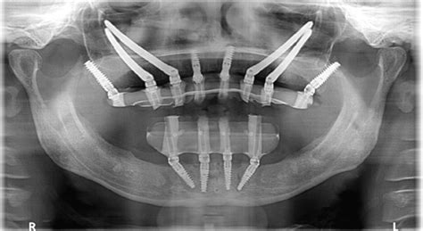 Zygomatic Implants Athens GA | Rescue Implants Buckhead, Conyers, Snellville