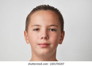 Teenage Boy Face Before After Acne Stock Photo 2201705207 | Shutterstock