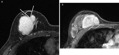 Differentiation between benign phyllodes tumors and fibroadenomas of the breast on MR imaging ...