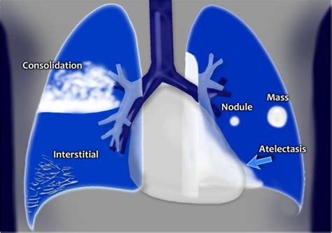 Lung Consolidation Vs Pleural Effusion