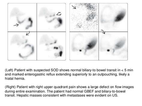 What Is A Hida Scan Used For - slideshare