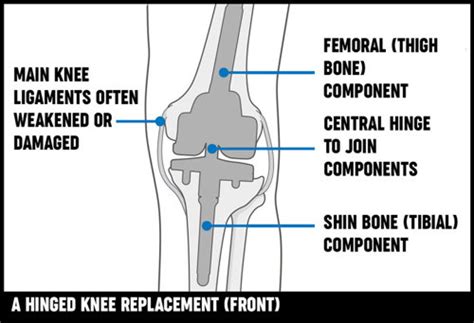 Knee replacement surgery | Treatment options | Versus Arthritis