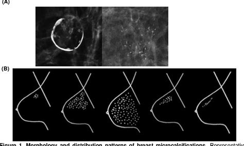 [PDF] Microcalcifications in breast cancer: From pathophysiology to diagnosis and prognosis ...