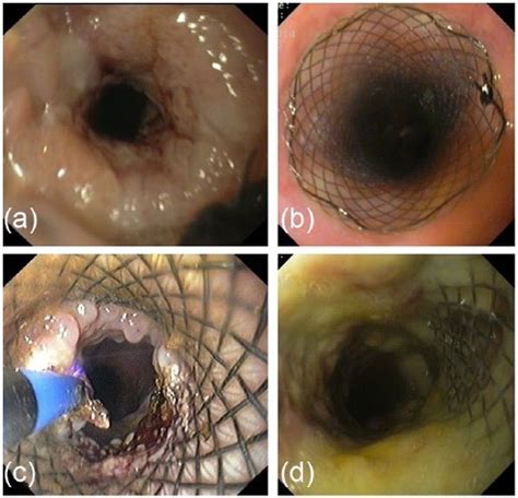 Endoscopic management of stent complications. (a, b) Restent... | Download Scientific Diagram