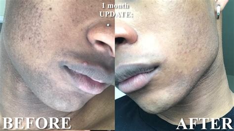 How to Fade a Beard shadow in 1 month | Get rid of hyperpigmentation - YouTube