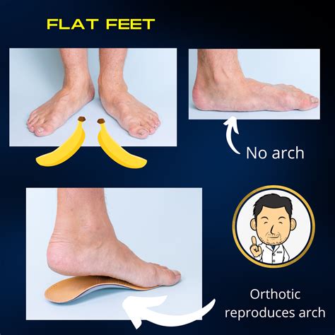 Treatment for Flat feet