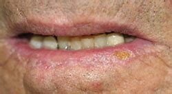 Recognition and Treatment of Actinic Cheilitis | AAFP